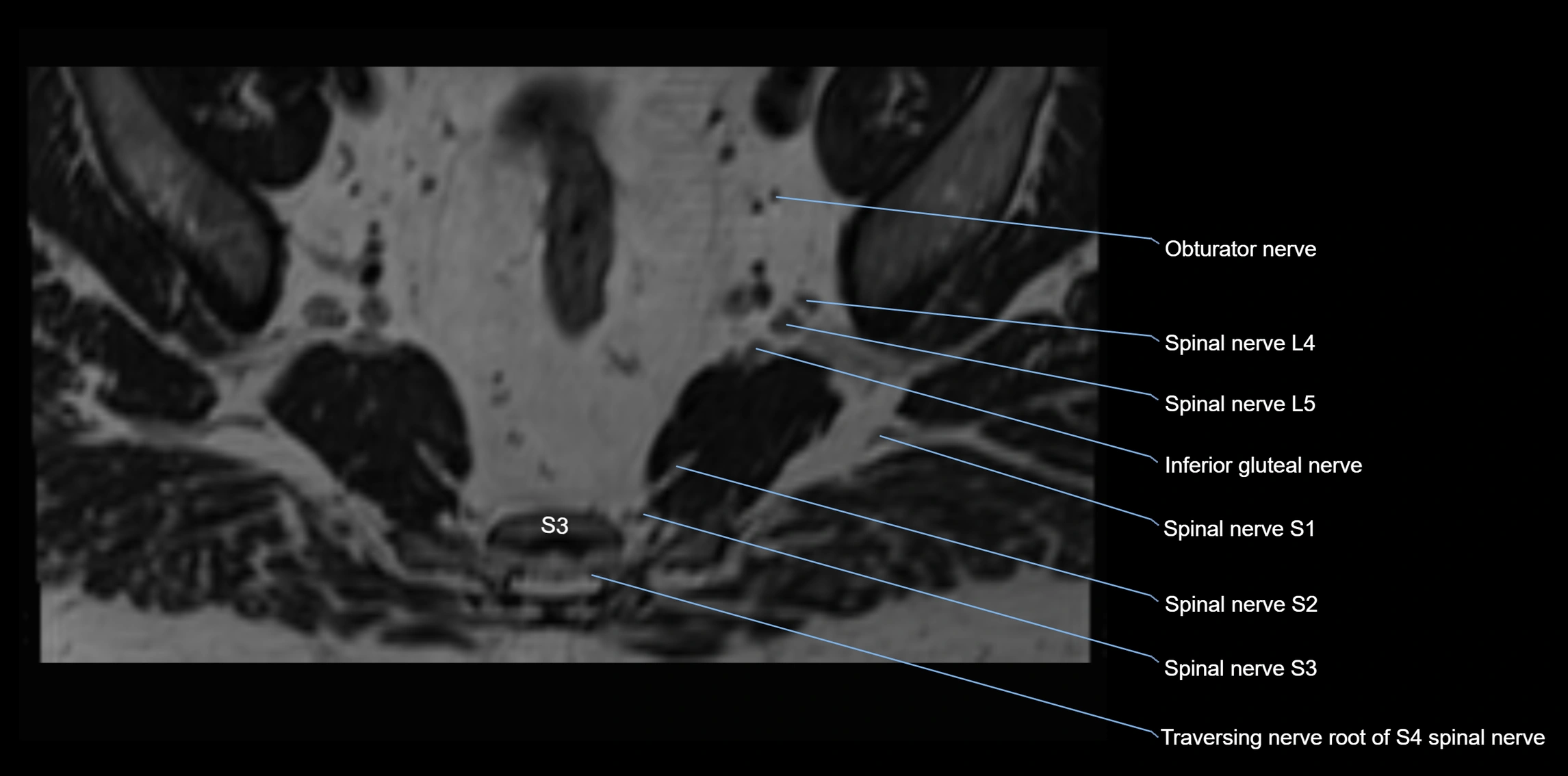 MR lumbosacral plexus axial cross sectional anatomy 3T  radiology  image-img-1008001-00096.webp